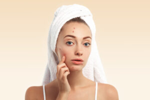 Manchas de acne na pele: como eliminar? 3